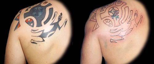 La remoción de tatuajes es una alternativa