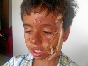 El pequeño Jacobo sufrió quemaduras en su cara que debieron ser tratadas por especialistas.