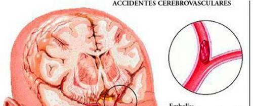 Cómo detectar y prevenir accidentes cerebro vasculares