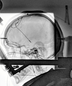 Neuromodulación con electrodos.